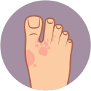 опрелость, мокнутие и мацерация кожи между пальцами ног и верхней тыльной части стопы